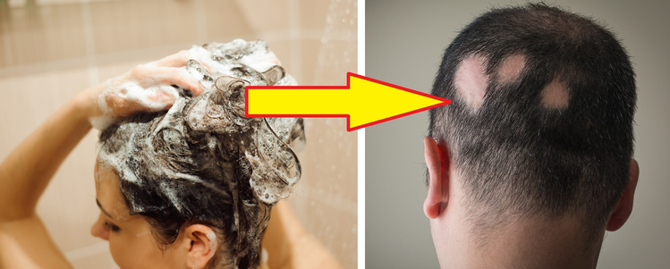 Wstydliwa choroba – łysienie plackowate. Poznaj 6 MITÓW na ten temat