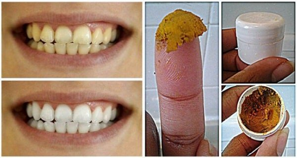 Zdjęcie Domowy i skuteczny trik, dzięki któremu pozbędziesz się przebarwień na zębach #1