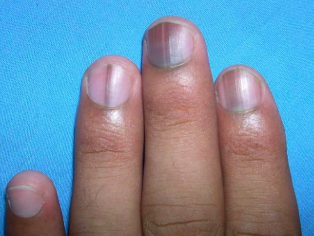 Zdjęcie Sprawdź, co wygląd twoich paznokci mówi o twoim zdrowiu! #1
