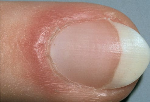 Zdjęcie Sprawdź, co wygląd twoich paznokci mówi o twoim zdrowiu! #7