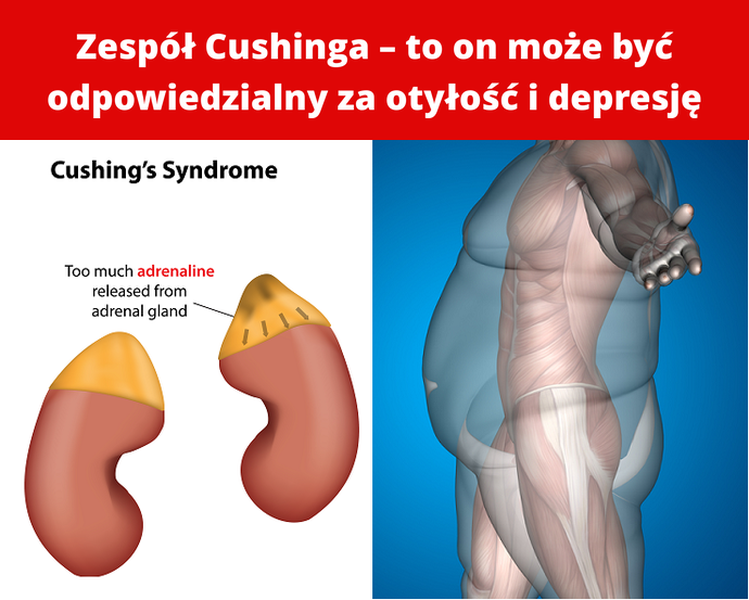 Zespół Cushinga – to on może być odpowiedzialny za otyłość i depresję