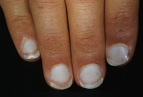 Zdjęcie Sprawdź, co wygląd twoich paznokci mówi o twoim zdrowiu! #2