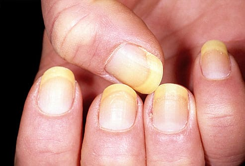 Zdjęcie Sprawdź, co wygląd twoich paznokci mówi o twoim zdrowiu! #4