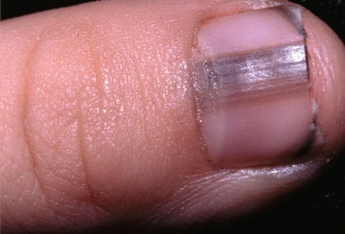 Zdjęcie Sprawdź, co wygląd twoich paznokci mówi o twoim zdrowiu! #6