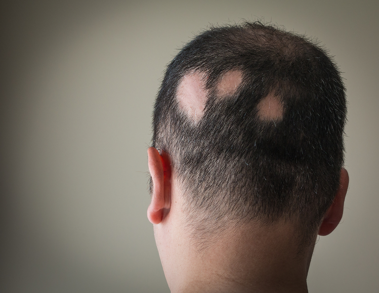 Zdjęcie Wstydliwa choroba – łysienie plackowate. Poznaj 6 MITÓW na ten temat #1