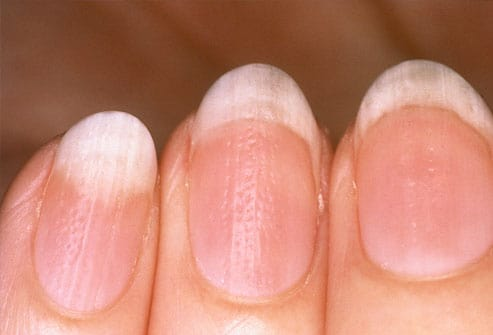 Zdjęcie Sprawdź, co wygląd twoich paznokci mówi o twoim zdrowiu! #3