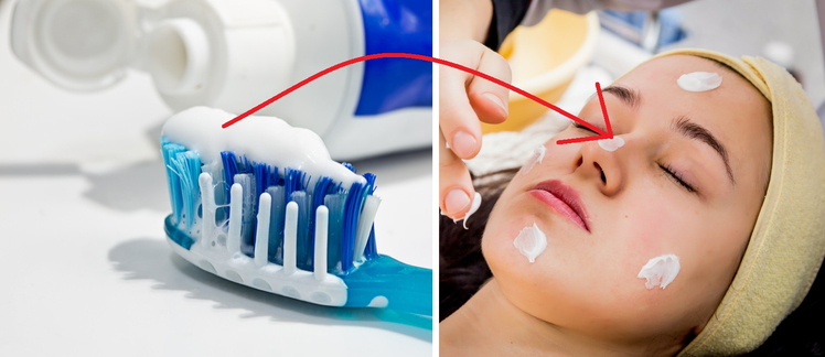 Pasta do zębów – czy działa na pryszcze i jak ją stosować?