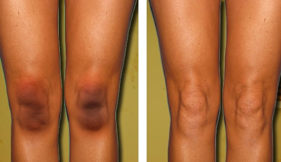Zdjęcie Jak rozjaśnić i wygładzić skórę na kolanach? 3 skuteczne sposoby #1