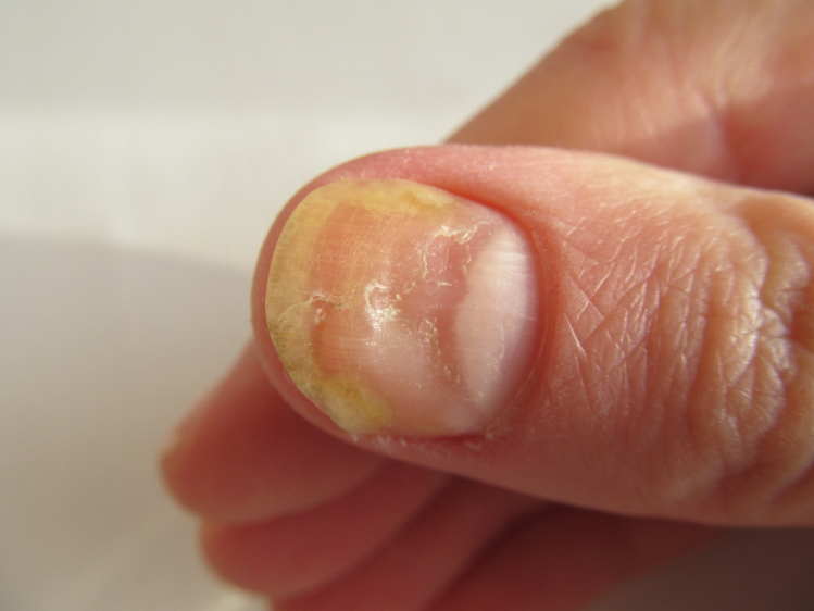 Zdjęcie Spójrz na swoje paznokcie i upewnij się, że nie masz ŻADNEGO z tych objawów! #1